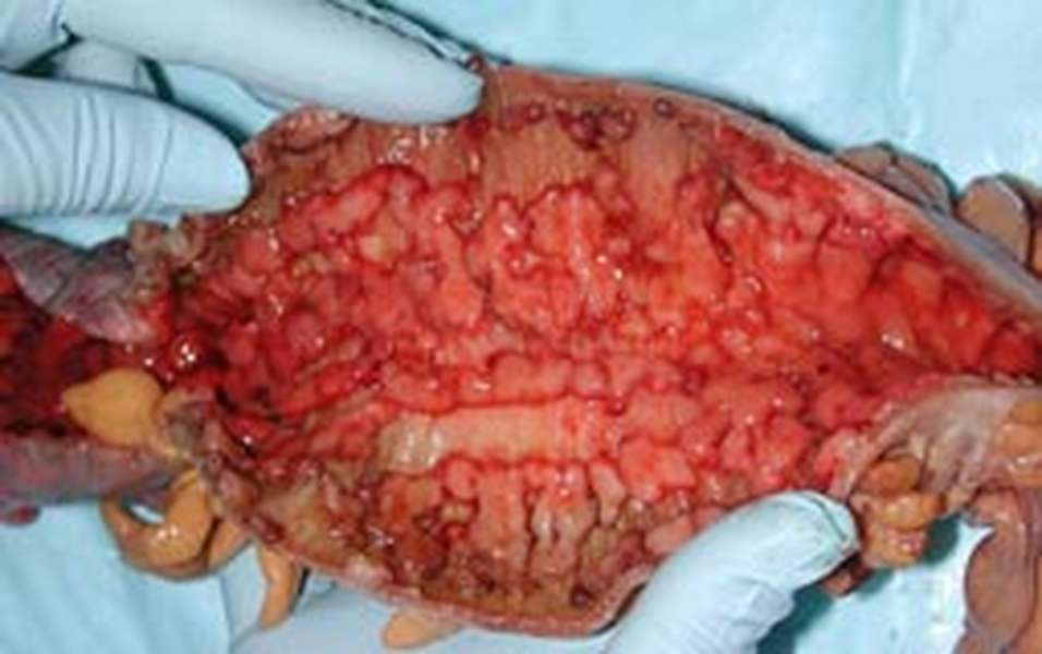 IBD - Hình ảnh minh họa